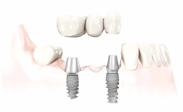 Dental Implant Bridges | Dentist | Manhattan