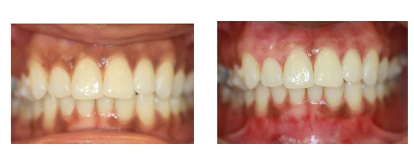 Before and After Laser Gum Bleaching