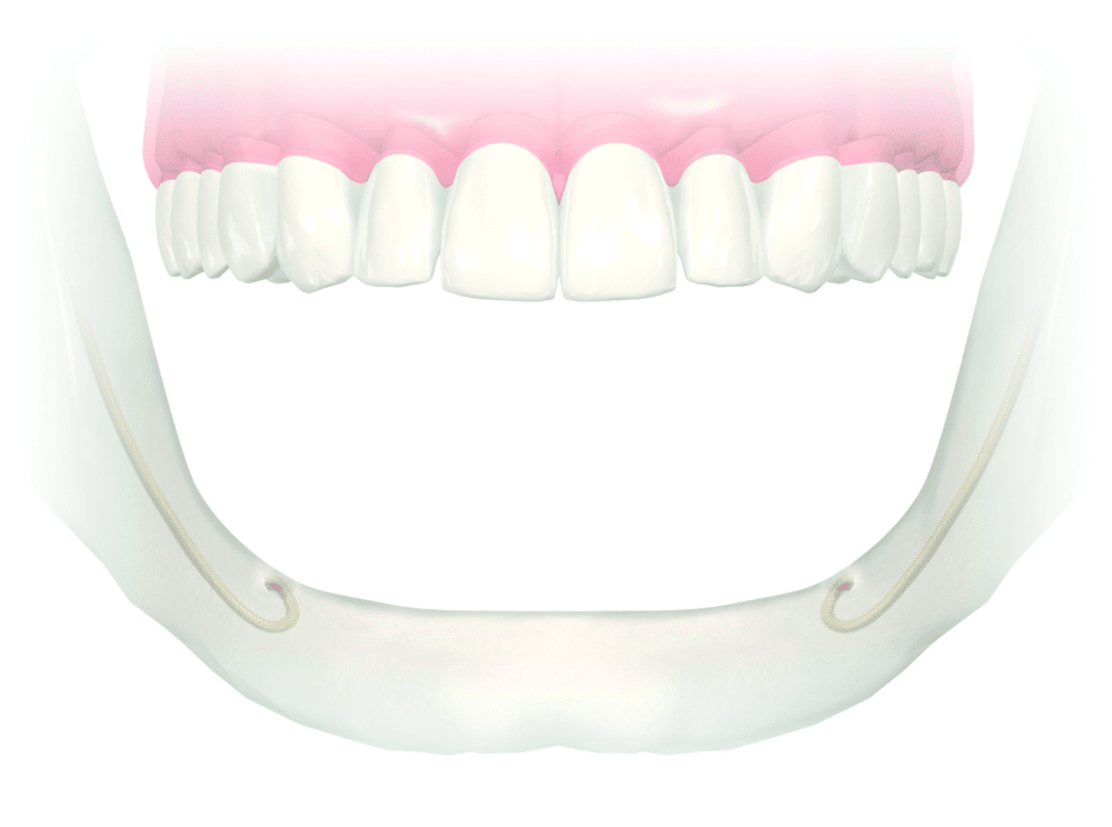 Dental Implants Can Support An Over Denture | Dentist | Dental Services | Manhattan