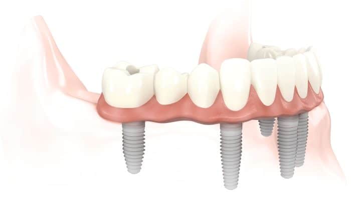 Same Day Dental Implants | Dentist | Dental Services | Manhattan