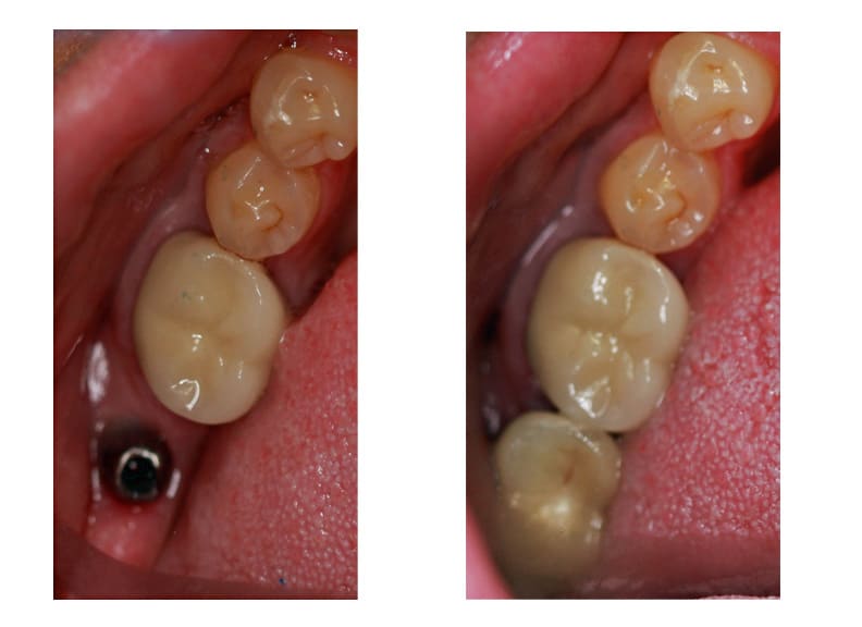 Single Tooth Dental Implant Images | Dentist | Dental Services | Manhattan