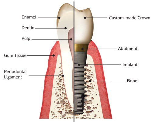 Dental Implant | Dentist | New York | Manhattan