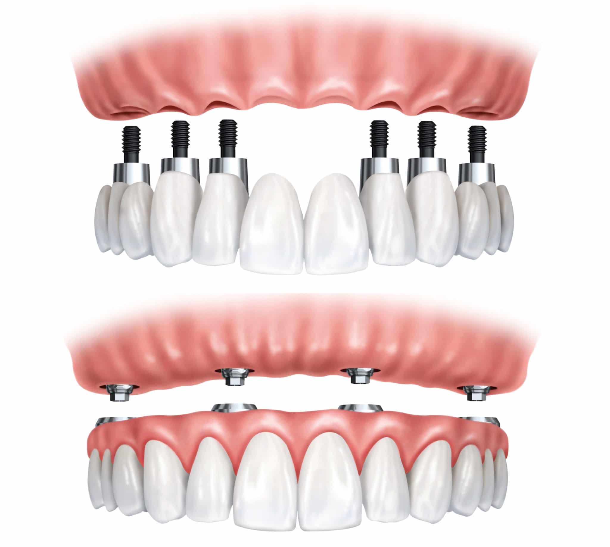 Teeth in a Day Dental Implants