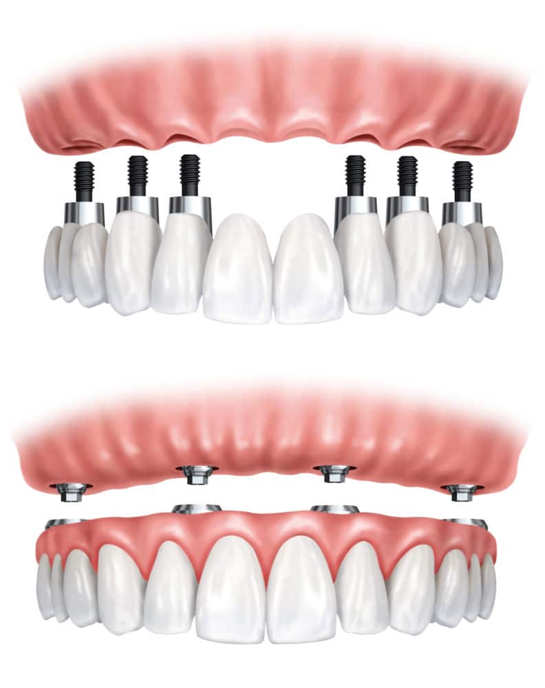 Teeth In A Day Dental Implants