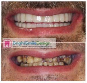 Dental Implants | Full Mouth Dental Implants Holistic Dental