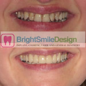 Veneers Cosmetic dentist NYC Dental Implants Cosmetic LANAP Invisalign and Holistic Dentist!