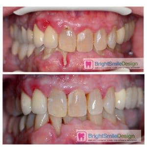 LANAP Before and After. Get result without cutting.