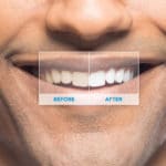 teeth bleaching nyc Dental Implants Cosmetic LANAP Invisalign and Holistic Dentist!
