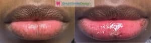 Get beautiful lip with laser lip depigmentation dark lip treatment